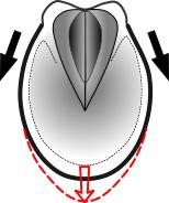 Fig 12: Narrow hoof shape: Focused hoof capsule expansion at the toe